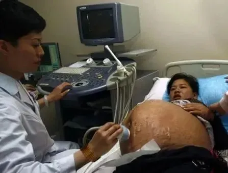 广州 38 岁孕妇剖腹产生下 6 胞胎