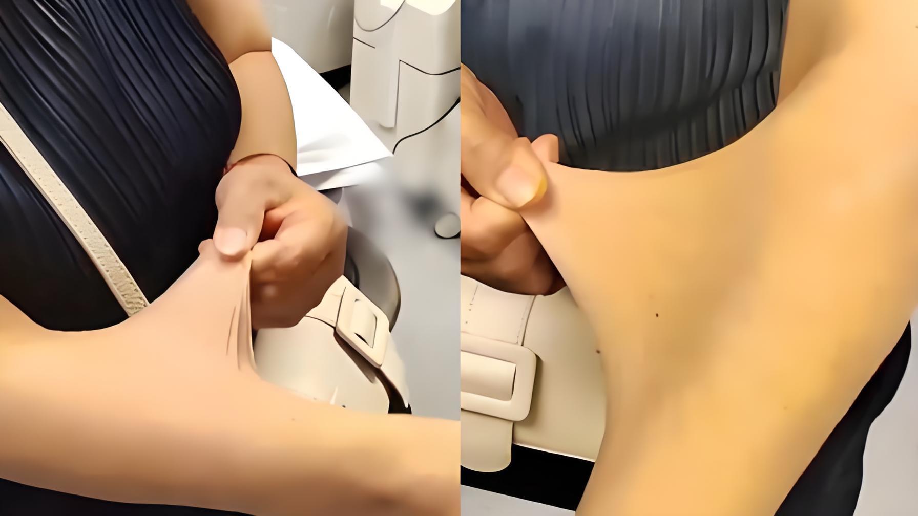 罕见！女子皮肤可拉伸几厘米如橡皮人，医生：皮肤弹力纤维松弛症