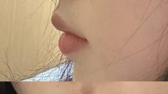 济南丰唇哪家最自然？张敬花医生啵啵丰唇术，花瓣唇设计0假感！