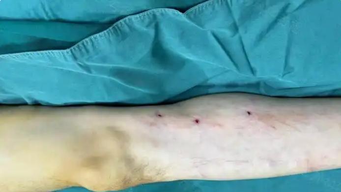 40岁厨师静脉曲张：短短一年腿发黑近溃烂，这个习惯很多人天天做