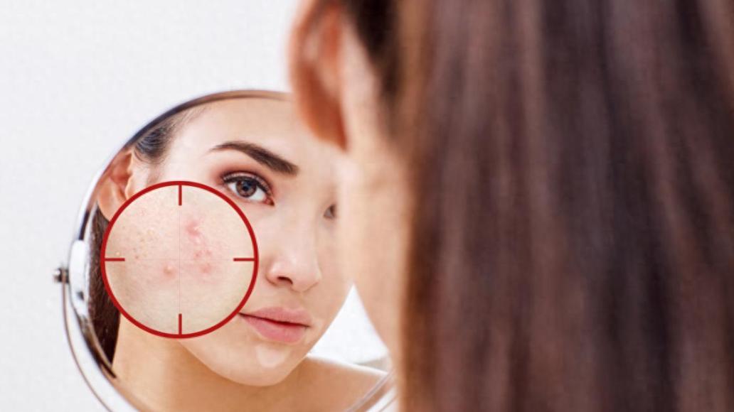 异维A酸软胶囊治疗痤疮怎么减药、停药？一文说清楚