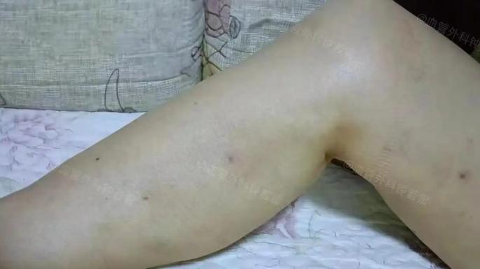 68岁勇敢一次，去武汉做静脉曲张微创，术后1个月分享这段经历