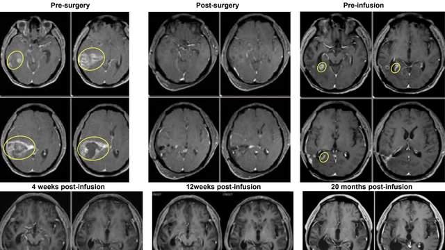 超20个月无瘤生存！不止黑色素瘤：数据揭示TIL疗法为肺癌、脑瘤、宫颈癌等提供“治愈”新可能