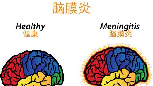 神内科普：脑膜炎、脑膜脑炎、脑炎是同一种疾病吗？
