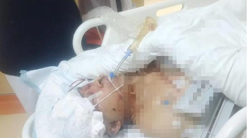 贵州村民遭300斤野猪撕咬头骨破裂生命垂危！伤人猛兽被特警击毙