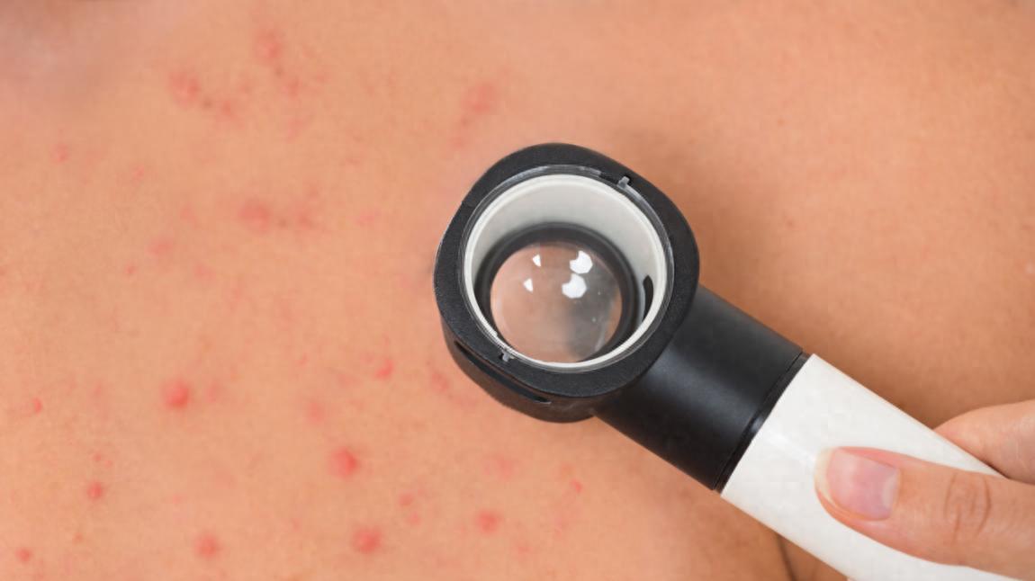 异维A酸软胶囊祛痘见好就收？正确服用才能减少复发