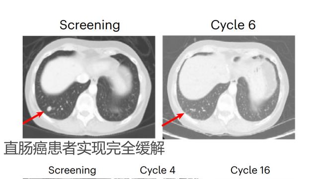 权威研究证实：癌症疫苗在乳腺癌、肠癌、肾癌、黑色素瘤...多癌种数据亮眼，安全有效！
