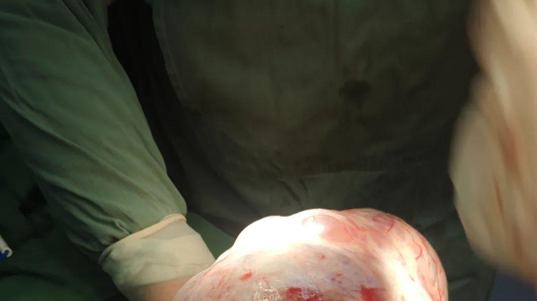 14斤巨大卵巢肿瘤成功切除，患者送锦旗赞誉医者仁心！