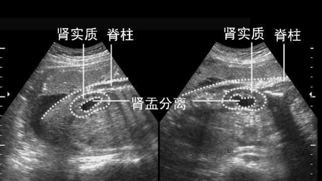 B超单上的4个子, 真的可以辨别男女吗？