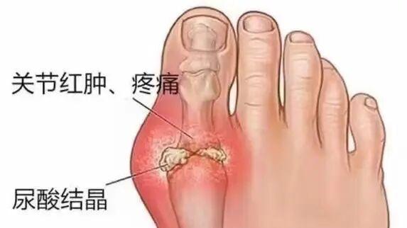 痛风发作像‘上刑’？床头备好这3样，20分钟内快速‘拆弹’，安稳睡到天亮！
