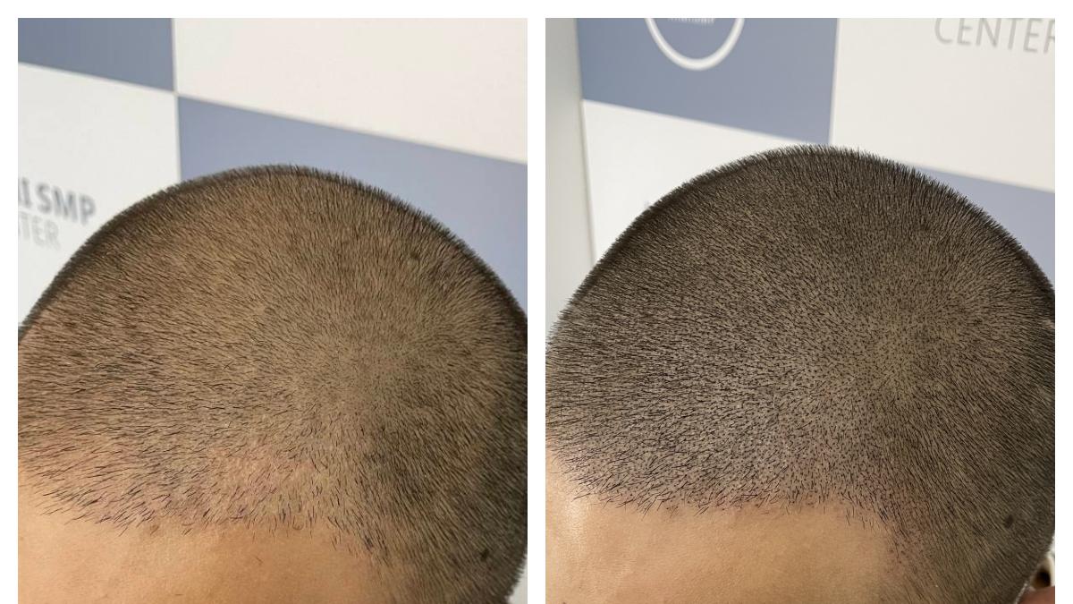 从“头发稀疏”到“发量王者”，纹发让我重拾抬头的勇气！