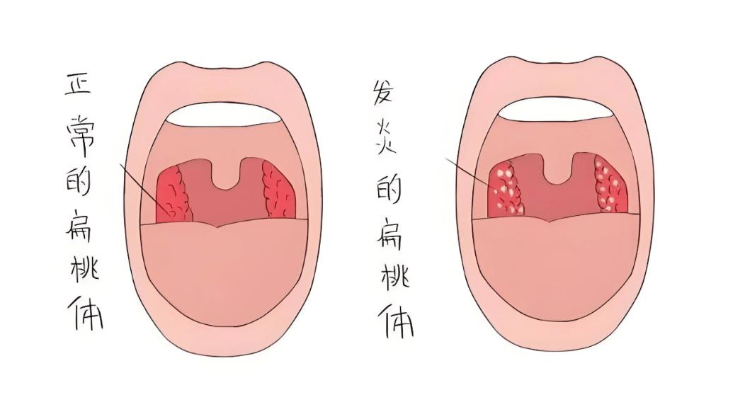 做了切除扁桃体手术，孩子免疫力会下降吗？