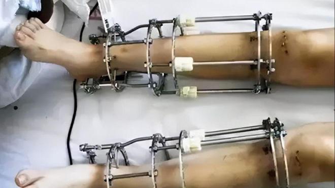 11年前花16万断骨，只为增高7.2厘米的李亚诺，如今怎样了？