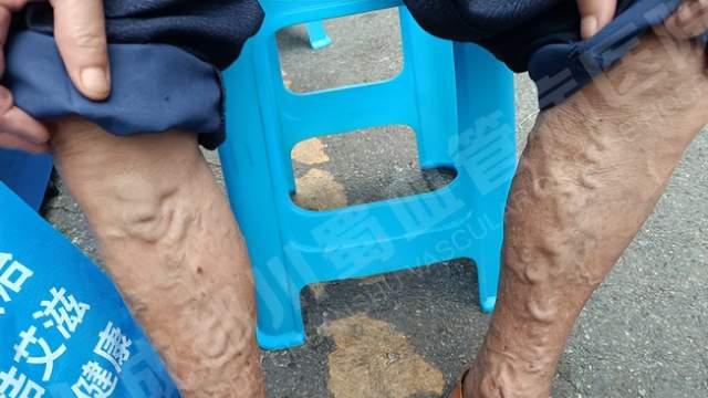 秋天腿部酸胀、水肿加重，这种菜最“补人”，既润燥又护腿，还能帮静脉曲张“减负”！这2种吃法最有效!