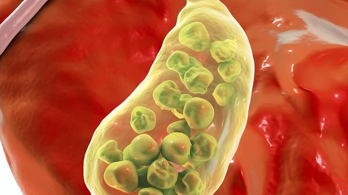40岁以后人群预防胆结石，出现发热、黄疸时，须立即就医