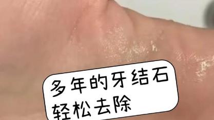 5年多的牙结石随便刷刷就没了？清除顽固牙石竟然真的只需这几步！