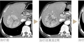 肝癌、肺癌、食管癌……多项临床研究展示质子治疗显著疗效，生存率超90%！