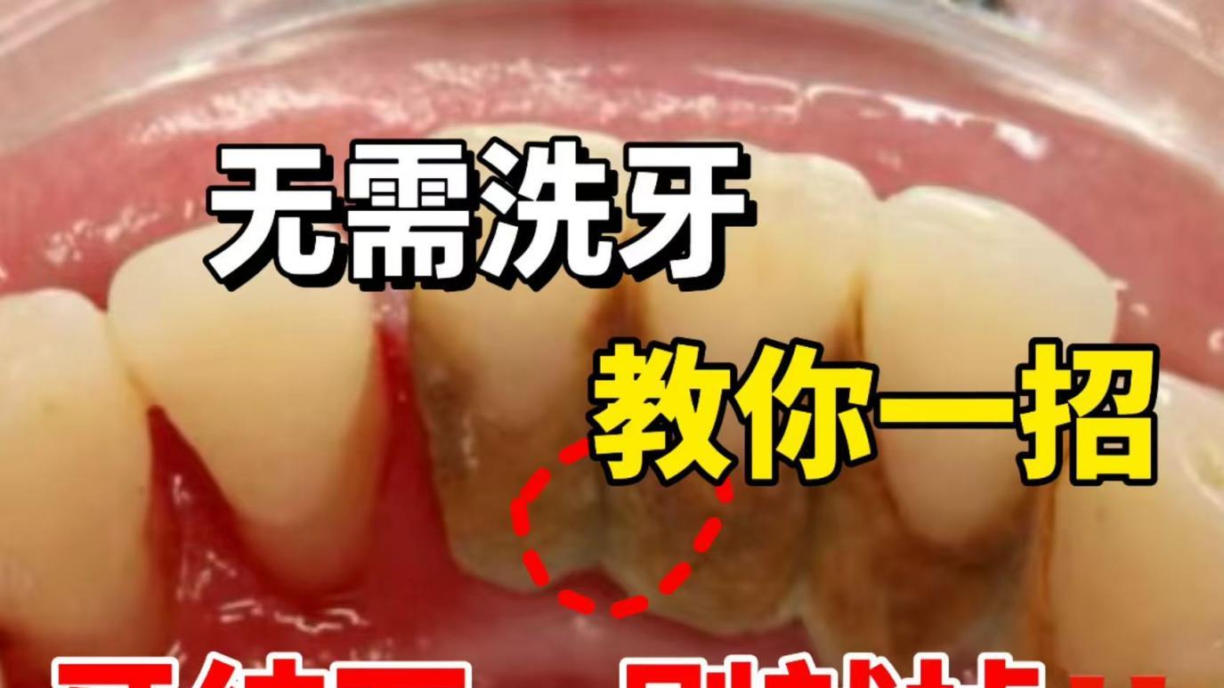 仅用35天！堆积如山的牙结石在家刷掉了！具体方法无偿分享！