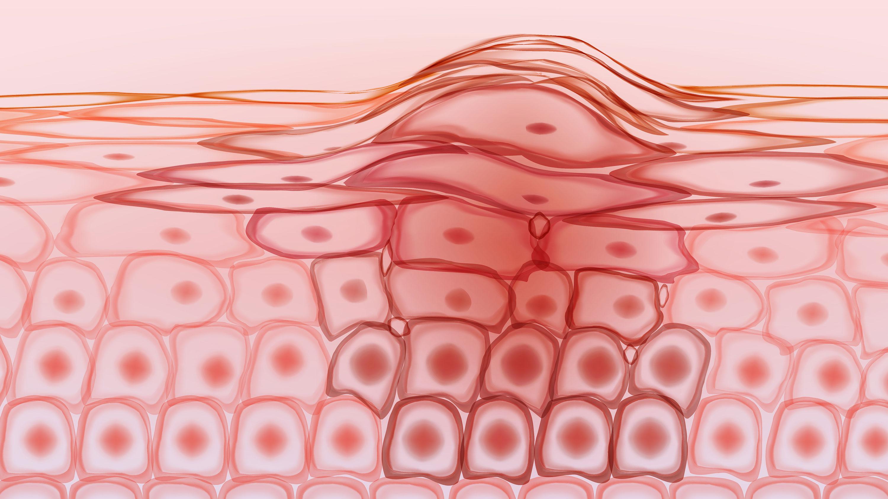 晚期皮肤鳞状细胞癌药物UNLOXCYT标签纳入长期随访结果