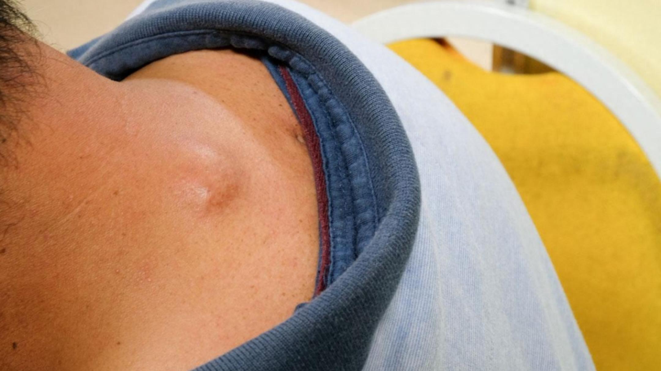 脂肪瘤像韭菜一样，割了又长！4味药健、化、利、通，斩草又除根