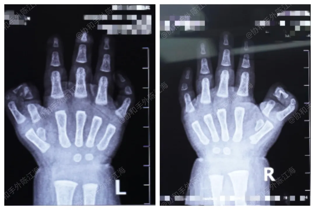多指│案例18《宝宝手上14根手指，妈妈怀疑是孕期喝中药了》