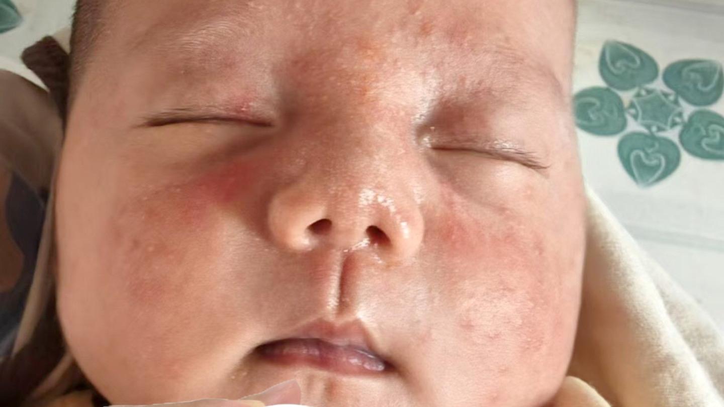 宝宝湿疹反复不好？宝妈必知的科学护理与预防指南