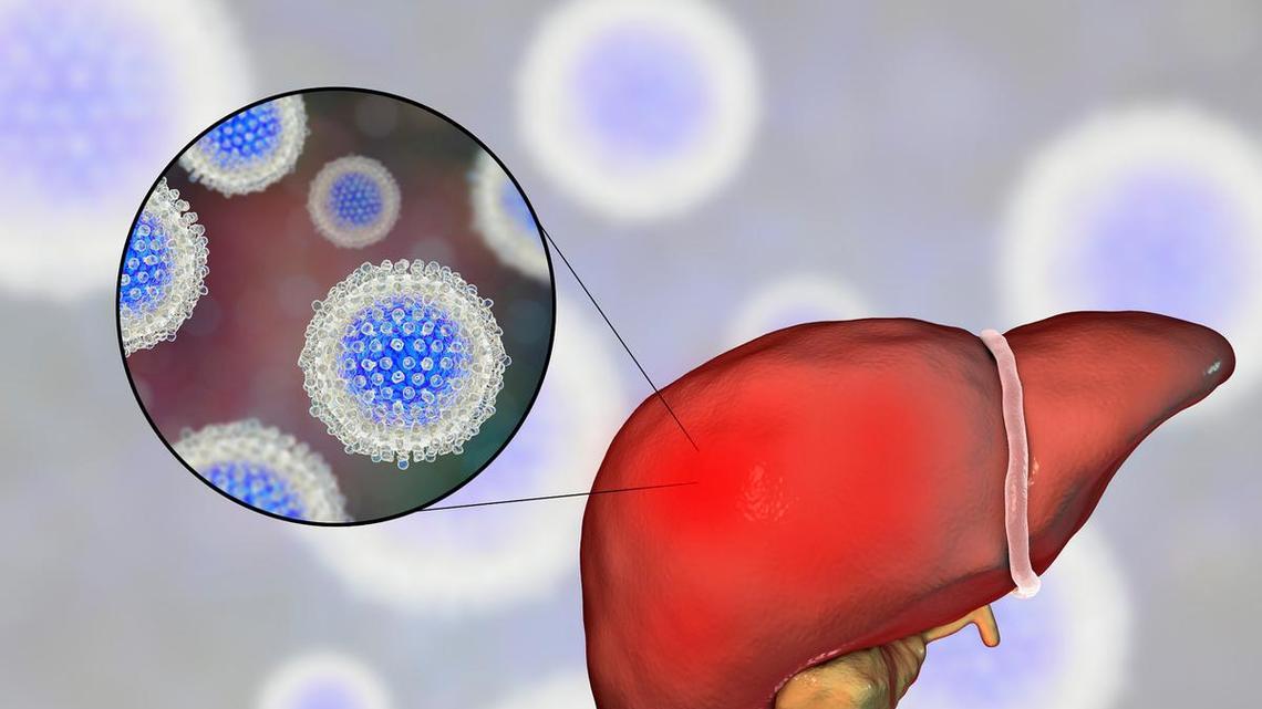 你的肝脏硬化了？很多人确诊时已经失代偿期，出现5类症状别忽视