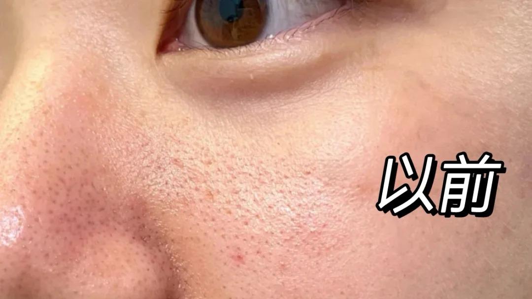 冬季皮肤泛红，如何预防“大红脸”？敏感肌必看的改善方法