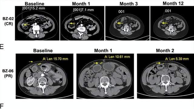 重磅！国内首款儿童专属CAR-T疗法获批，90%患儿肿瘤缓解，中位总生存期近两年
