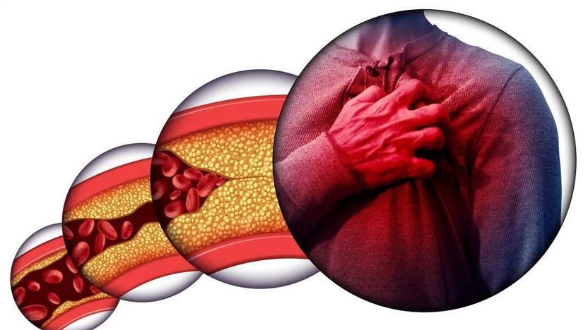 出现麻、肿、跛、晕可能是血栓求救信号，出现4类症状，立即就医