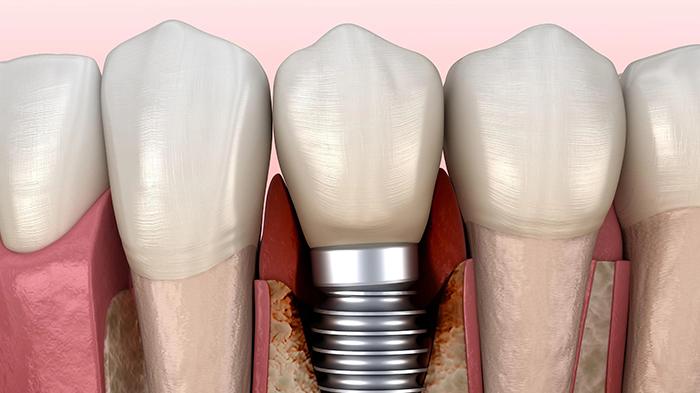 牙周刮治完可以立即种植牙么？—义乌口腔种植