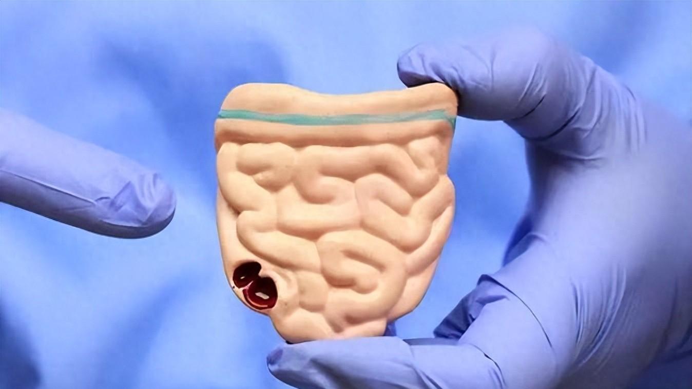 肠癌不是大病，但别让它偷走你的生命，3类症状别忽视，及时就医