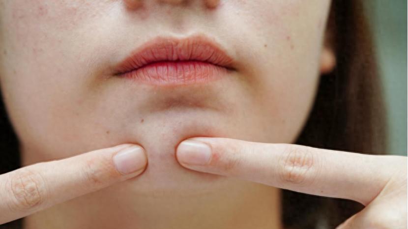 异维A酸软胶囊吃了一个月，痘痘反而更多，要停吗？