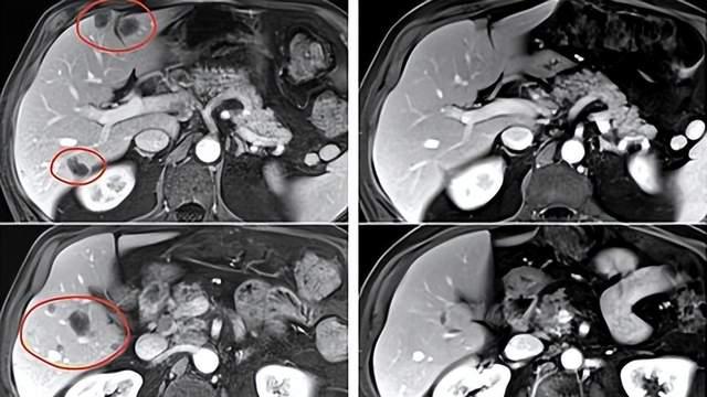 当癌症扩散至肝、肺、大脑……他靠TIL疗法实现了治愈！TIL疗法向黑色素瘤、胃癌、肠癌发起进攻