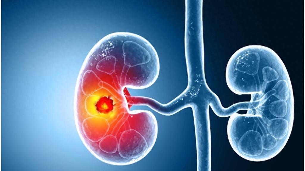 疲惫水肿、食欲不振，不是年纪大了，小心肾衰竭，早期治疗是关键