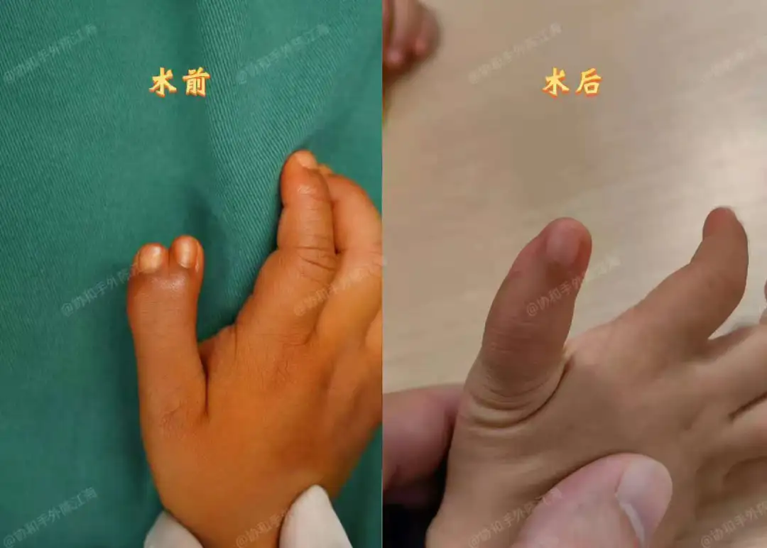 宝宝多指，妈妈说一开始我们想简单了