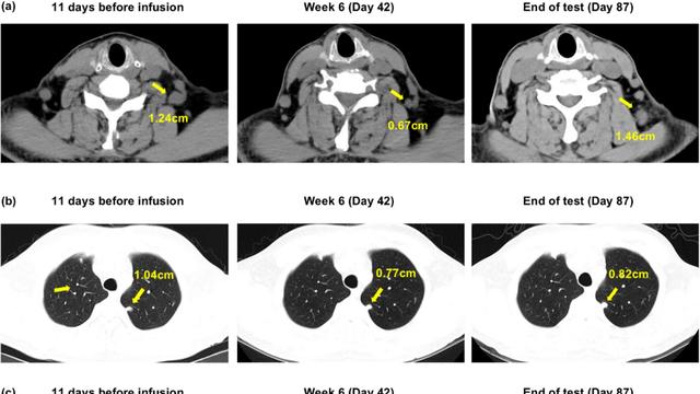 肿瘤缩小81%！TCR-T细胞疗法在胰腺癌、滑膜肉瘤、肝癌患者中展现治疗潜力，实现74%疾病控制率