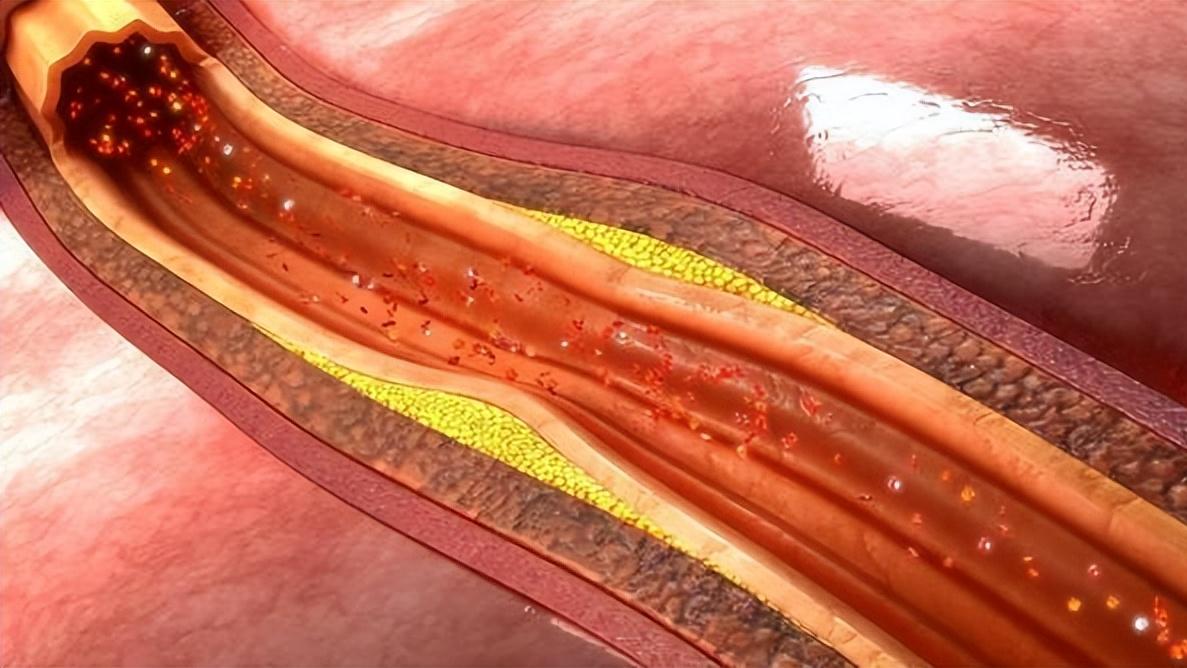 调查数据显示，有人30、40多岁就中招了，请大家不要掉以轻心