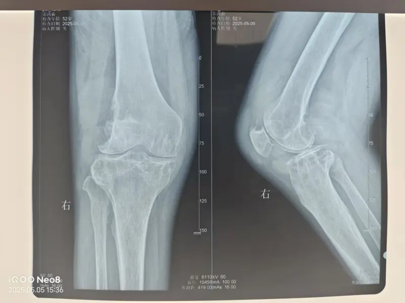 痛风7年把关节泡成