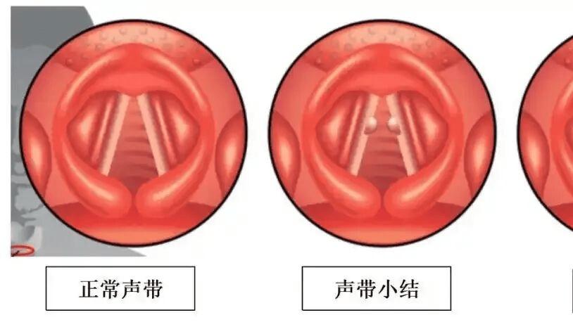 声带小结和息肉，到底哪里不一样？