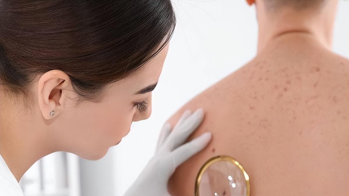 后颈突然冒颗“小黑点”，不是上辈子欠谁的眼泪，而是痣