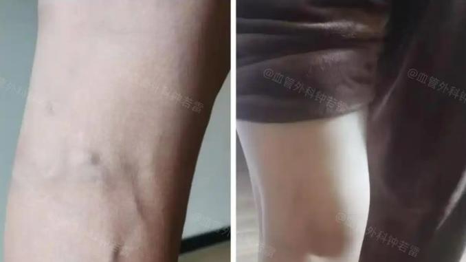 腿沉酸胀总乏力？别当累的，可能是静脉曲张在预警