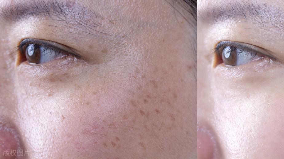 闺蜜祛色斑成功！原来关键在这4个点，新手必看