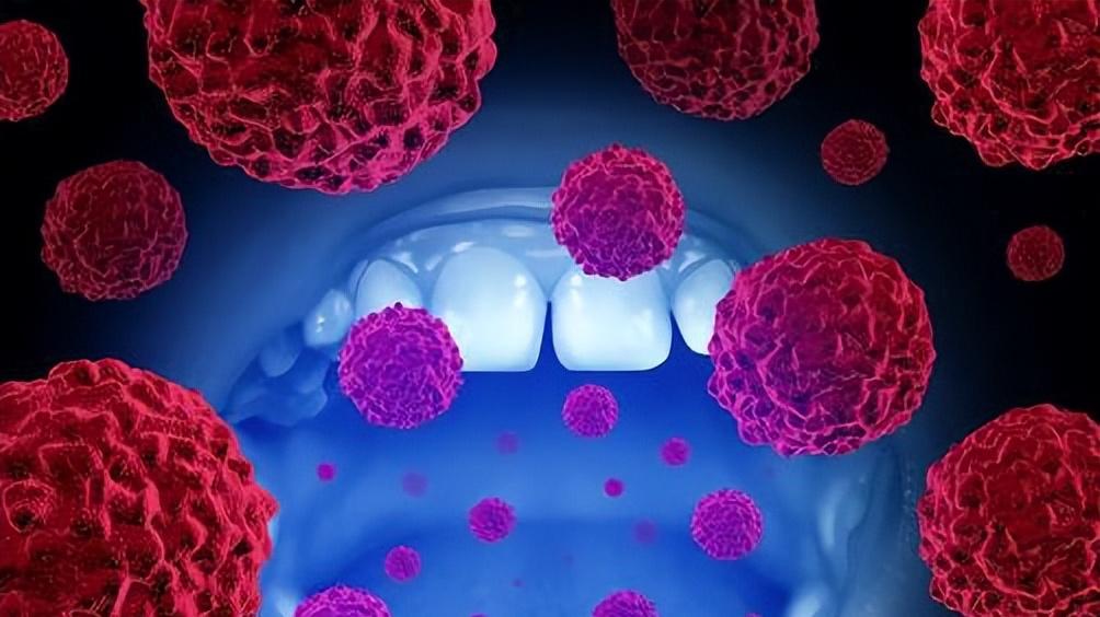 超过2周不愈合的口腔溃疡，别忽视小心口腔癌，早期治疗生存率85%