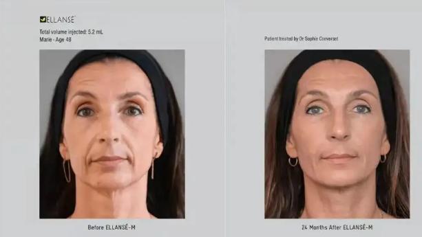 少女针的恢复期，被严重低估了