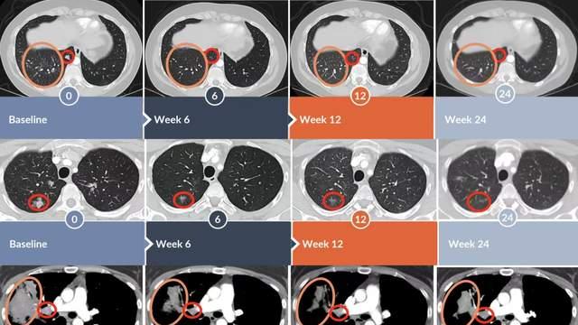 68.8%患者病情控制！TCR-T疗法治疗实体瘤临床数据积极，肺癌、肠癌、黑色素瘤患者肿瘤显著缩小