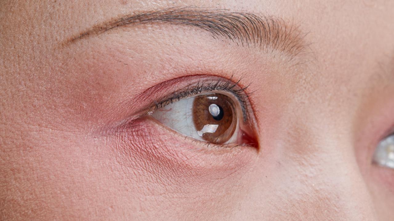 别再忍红血丝了！搞懂这几点，改善效果稳不反弹