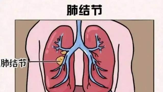 肺结节≠肺癌！95%以上是良性的，但4类人群需注意，及时就医筛查