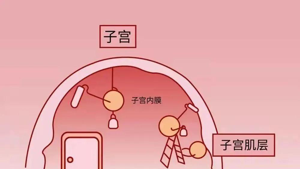 壹元优孕——试管前必须做宫腔镜检查吗？看完心里有底了