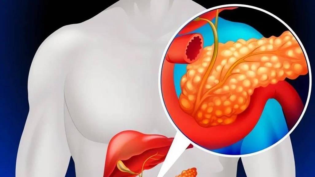 突发急性胰腺炎要及时就医，远离三大元凶，出现4类症状别忽视